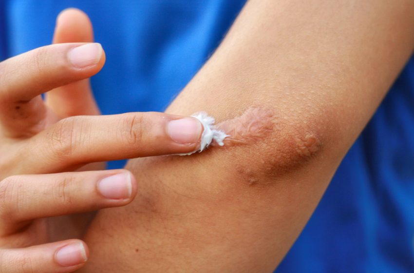  4 Amazing Tips to Treat Keloids Naturally at Home